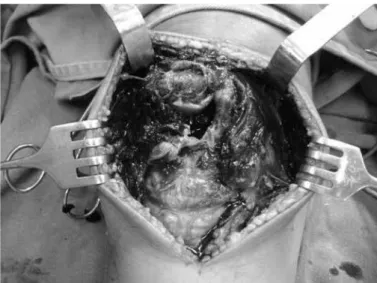 Figure 4 – Intraoperative view of the left knee. 