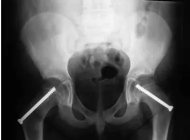 Figure 1 – Preoperative radiograph showing proximal epiphysiolysis on  the left side.