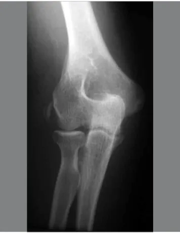 Figure 2 –  Radiograph of the elbow, showing calcification of the lateral epicondyle.