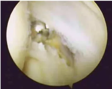 Figure 6 –  Arthroscopic image of the elbow showing debridement of the SREC tendon  after removal of the capsule.