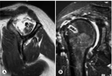 Figure 2 – (A) Preoperative magnetic resonance imaging, showing atrophy of the mus- mus-cle belly of the supraspinatus; (B) postoperative magnetic resonance imaging, showing  renewed tearing of the tendon of the supraspinatus, with UCLA = 10.