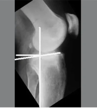 Figure 1 –  Method for measuring the tibial slope angle.