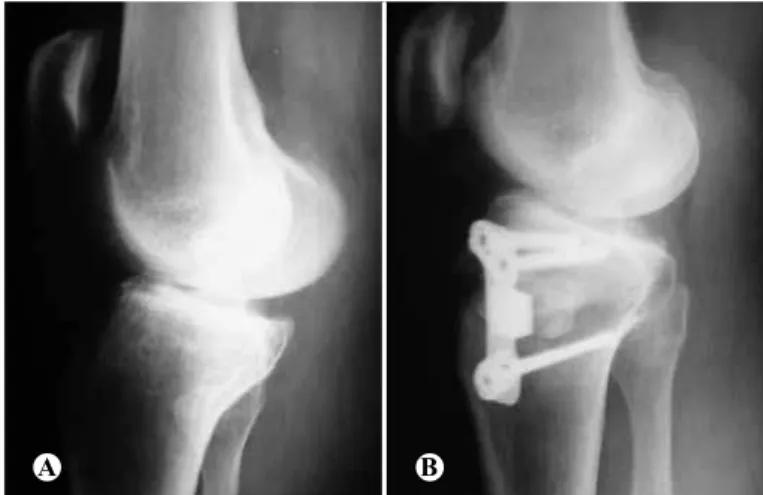 Figure 3 – (A) Preoperative radiograph; (B) Postoperative radiograph showing reduction of  the patellar height in a patient who underwent osteotomy and fixation using a Puddu ®  plate.