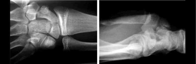 Figure 1 – Pseudarthrosis of the tubercle of the scaphoid, deviated to the left. Note open growth plate on the distal radius and ulna.