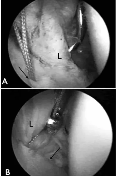 Figure 1 – View through the posterior portal of the right shoulder in  deckchair position