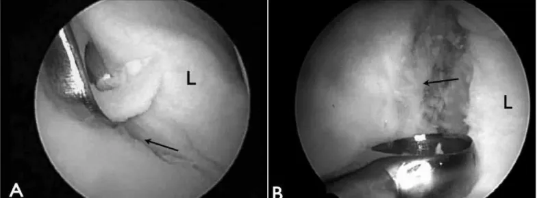Figure 2 –  Opening of the anterior joint margin of the glenoid cavity (glenoid rim) using a curette