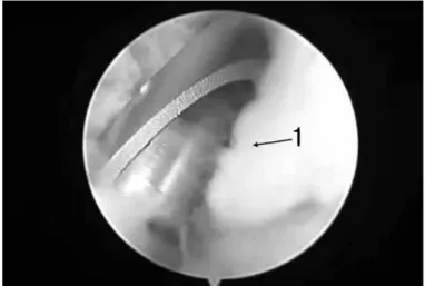 Figure 1 – 1) Anterior capsule.