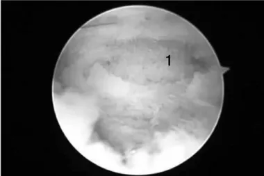 Figure 5 – 1) Radius after arthroscopic excision. 2) Capitellum.