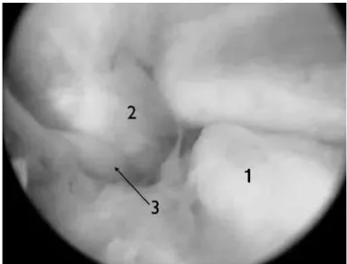 Figure  9 – 1) Olecranon. 2) Medial collateral ligament. 3) Ulnar nerve.