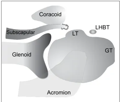 Figure 2 – Representative diagram showing the three types of com- com-plete tearing of the subscapular tendon: undamaged (A); affecting  the upper third of the craniocaudal extent (B); affecting two thirds  of the extent (C); and total (D)