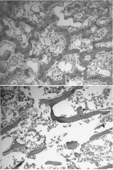Figure 6 – Photomicrograph of histological section through a bone  graft with the characteristics of viability (left), in which the bone  marrow region presents abundant cellular elements and osteogenic  matrix; and section showing absence of viability (ri