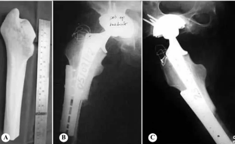Figure 1 – Radiograph on 46-year-old female patient, showing signs  of loosening of THA (Muller prosthesis), with AAOS type II acetabular  defect and type IV femoral defect (4) .