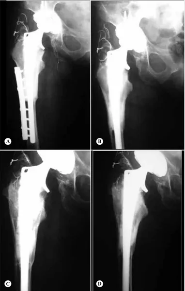 Figure 3 – (A) Radiograph produced two years after the operation. 