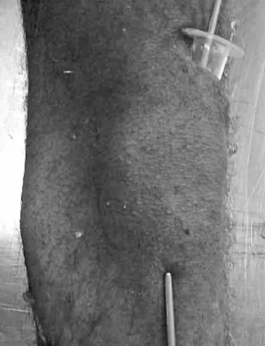 Figure 2 –  Soft-tissue protector positioned using guidewire, de- de-monstrating the ease of locating the entry point, and external wire  showing direction of the tibial medullary canal.