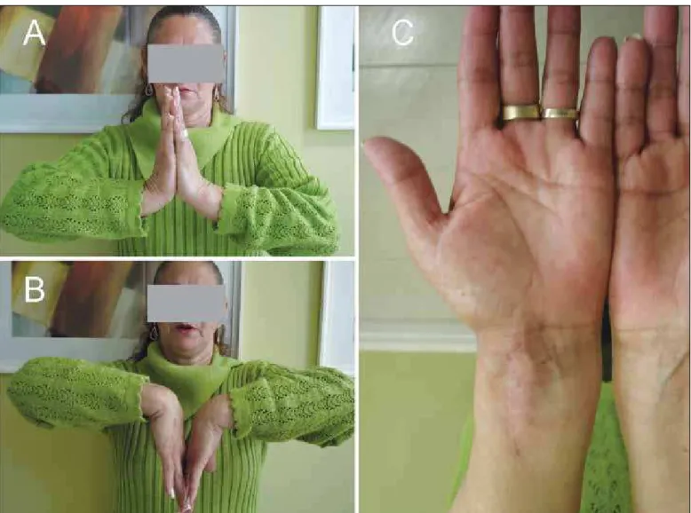 Figure 12 – Assessment of wrist mobility after 12 months of postoperative evolution. Extension of 60 degrees (A) and flexion of 80  degrees (B)