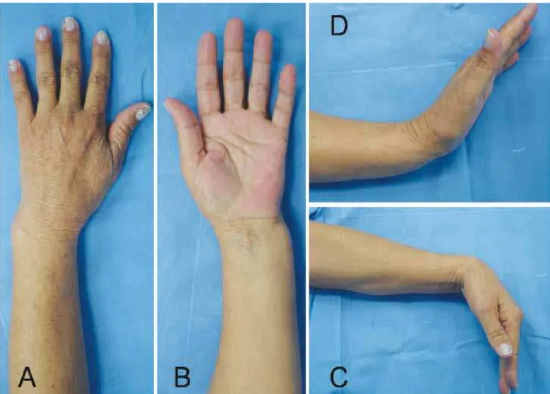 Figure 3 – After conservative treatment, the patient presented pain at the fracture site, deformity (A and B) and diminished movement,  while flexion was maintained (C)