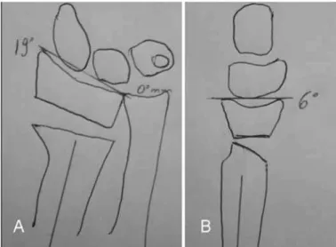 Figure 4 –  Planning for osteotomy by means of trial and error  method. Through comparison with a radiograph of the  contrala-teral wrist, it was possible to predict the amount of angling and  stretching needed to achieve correct bone positioning.