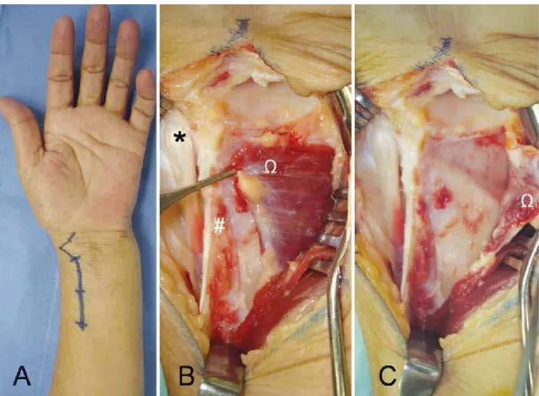 Figure 5 – Incision of 8 to 10 cm above the radial flexor of the carpus in order to access the distal radius (A)