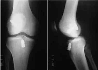 Figure 1 – Radiograph on right knee in anteroposterior and lateral  views before the operation, of a patient in the single-band group.