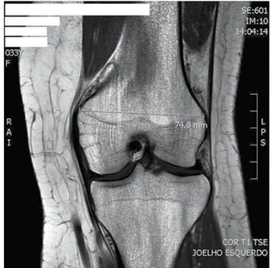 Figure 1 – Measurement of the anteroposterior distanced of the  lateral condyle. 
