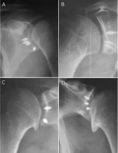 Figure 2 – Glenohumeral degenerative alteration: A) No arthrosis; B)  Samilson I; C) Samilson II; and D) Samilson III
