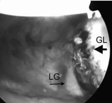 Figure 1 – Case 6: arthroscopic view of the right shoulder with the  viewing device introduced through the anterosuperior portal, showing  the detachment of the anterior labrum (larger arrow) with medial  displa-cement (smaller arrow)