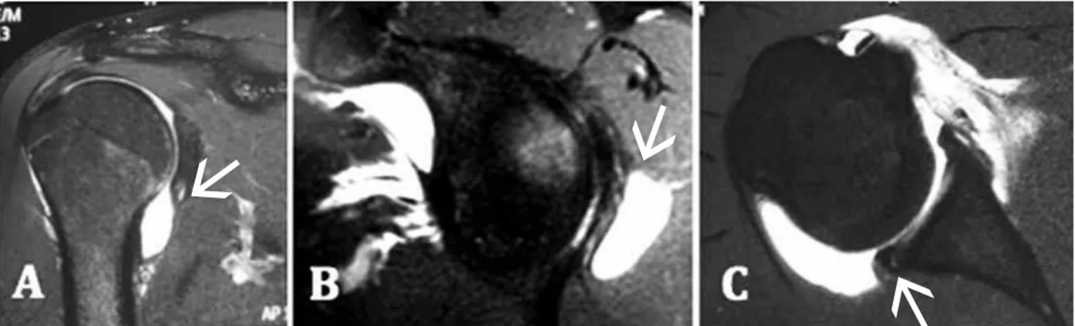 Figure 7 – Case 1: Magnetic arthro-resonance images of the right shoulder of a baseball player who did not achieve improvement of his pain through  the rehabilitation program: (A) T2 coronal slice showing lesion of the posteroinferior labrum (arrow); (B) T