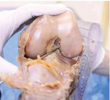 Table 2 – Length of the femoral tunnels, in mm, drilled at 90, 110 and  130 degrees of flexion.