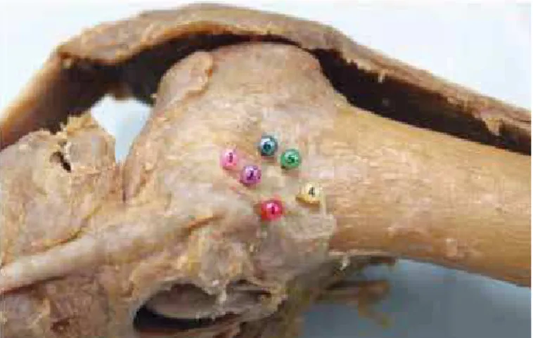 Figure 4 – Lateral view of an anatomical left-knee specimen. The ma- ma-rkers 1, 2 and 3 indicate the exit points in the lateral femoral condyle of  the posterolateral tunnels drilled at 90, 110 and 130 degrees of flexion,  respectively