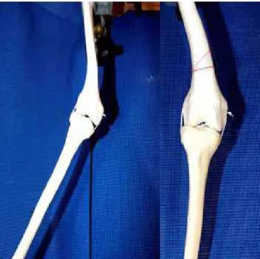 Figure 3 –  (A) definition of resection wedge. (B) Projection of correction 
