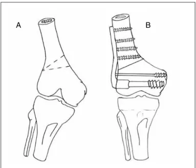 Figure 10 – (A) Schematic drawing of the traditional site for varus rota- rota-tional osteotomy