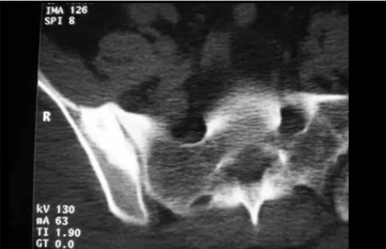 Figure 2 – Case 1: radiograph of the surgical specimen from the right  iliac bone. Note the resected nidus and the bone sclerosis.