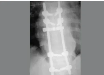 Figure 8 – Radiograph in lateral view showing arthrodesis of T8-L1.