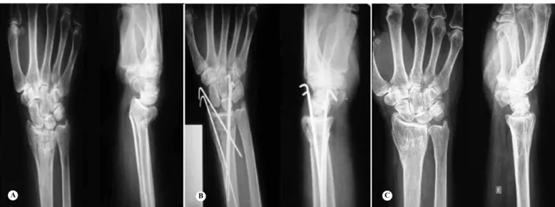 Figure 2 –  Patient aged 79 years. (A) – X-ray showing unstable reducible Intra-articular fracture