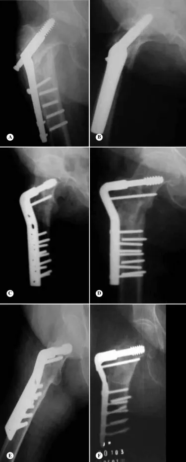 Figure 2 – Preoperative planning for valgization osteotomy of  the proximal femur, to correct the varus deformity caused by  transtrochanteric pseudoarthrosis (A and B).