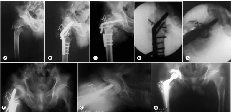 Figure 3 – 78-year-old patient with pseudarthrosis and failure of the material (A, B and C), who underwent osteotomy that was fixed with  a DHS of 150 0  and valgization to 154 0  (D and E)