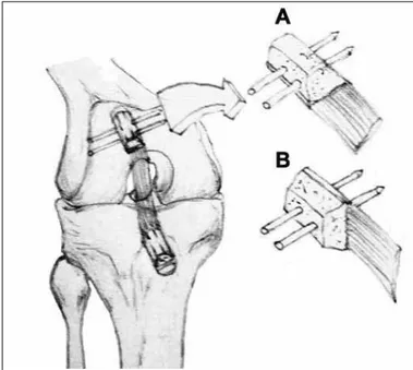 Figure 3 – Illustration demonstrating the two bone-block fixation  methods using transverse pins.
