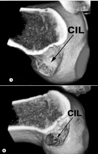 Figure 4 –  Computed tomography scan showing the location of  the femoral tunnel, posterior to the lateral intercondylar crest