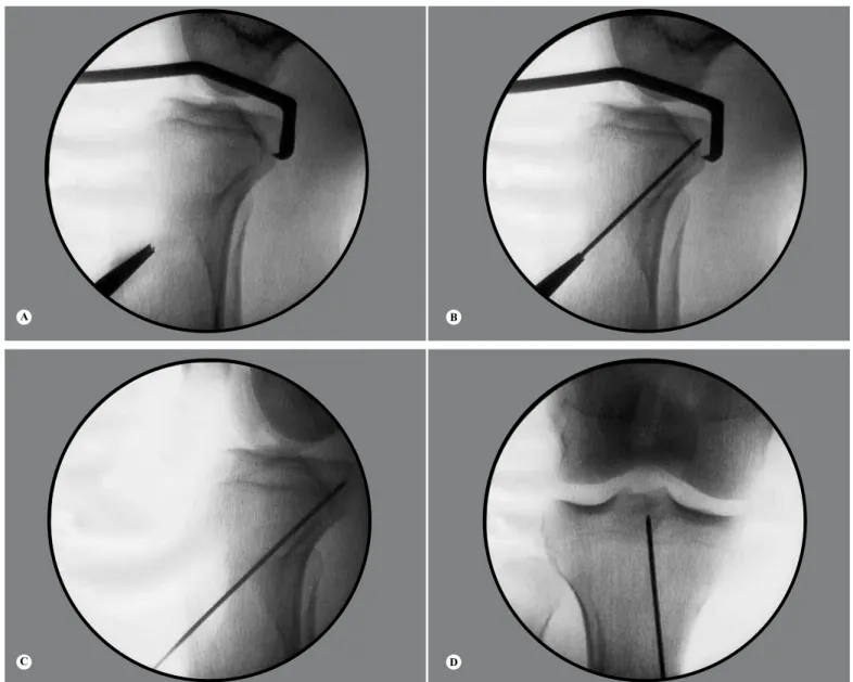 Figure 1 - (A) Positioning of the tibial guide. (B) Passage of the guidewire through the tibia