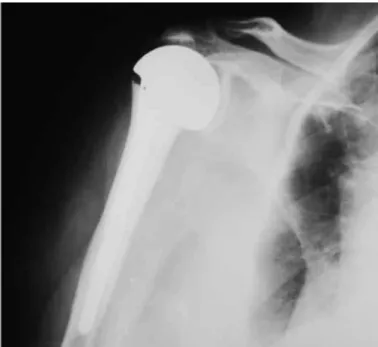 Figure 1 – Anteroposterior radiograph on a shoulder with ar- ar-thropathy due to a rotator cuff injury.