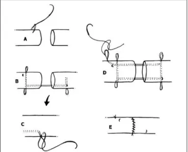Figure 5 -  Tsai technique (Lim and Tsai, 1996) 25 .(FOUR AND SIX STRANDS) WITH EARLY ACTIVE MOBILIZATION