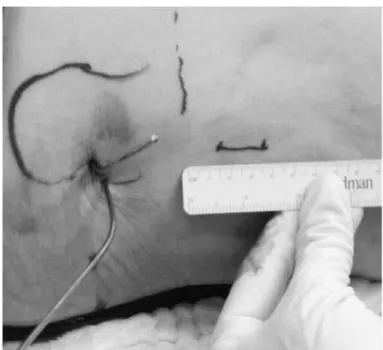 Figure 3 – Reduced fracture, provisionally fixed with two percu- percu-taneous Kirchner wires.