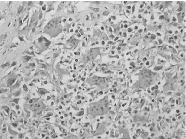 Figure 7 – Malignant giant-cell neoplasia, compatible with pleo- pleo-morphic sarcoma.