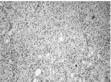 Figure 6 – Lesion showing high cellularity and cell atypia, com- com-patible with fusocellular sarcoma, corresponding to the  undif-ferentiated area (hematoxylin-eosin: 100x).