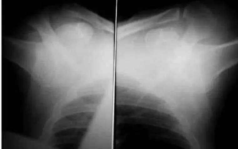 Figure 1 – Patient with inferior dislocation of the shoulders  bilaterally.