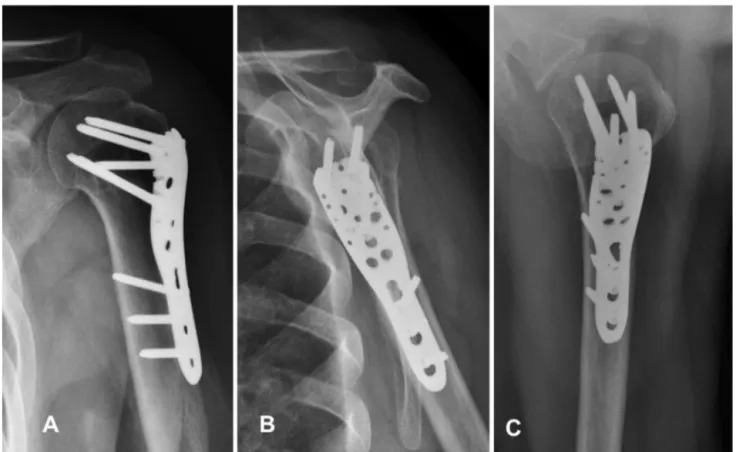 Fig. 5 – Radiographic evaluation of a case with a well-positioned plate and adequately reduced fracture