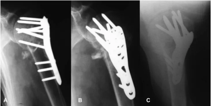 Fig. 7 – Radiographic evaluation of a case with secondary varus collapse and protrusion of crews into the joint