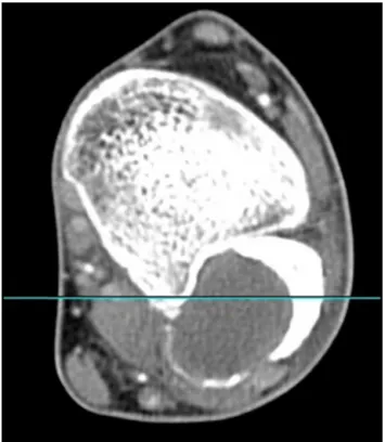 Fig. 2 – Helicoid computed tomography (March 19, 2009).