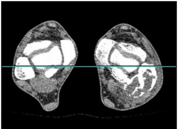 Fig. 3 – AP and lateral radiographs of the ankle, one year after the surgery.