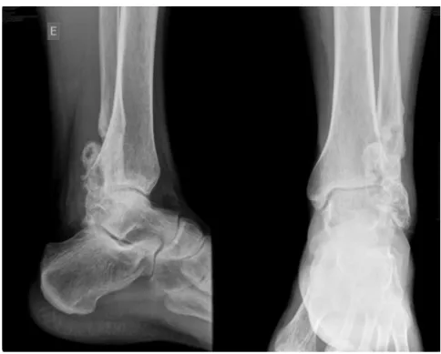 Fig. 6 – Radiograph of the ankle, one year and two months after the second surgery.